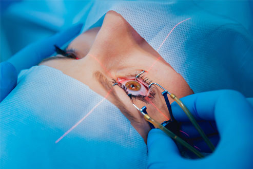 chirurgie-au-laser
